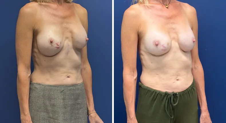 Before and after revision breast augmentation: woman's breasts