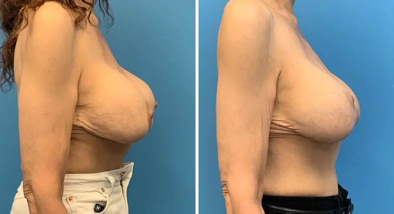 Before and after revision breast augmentation: patient's breasts from the right side