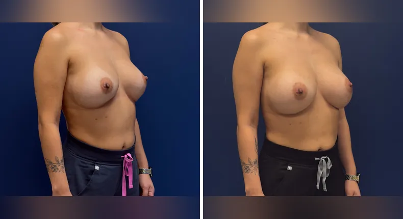 Before and after revision breast augmentation: patient's breasts