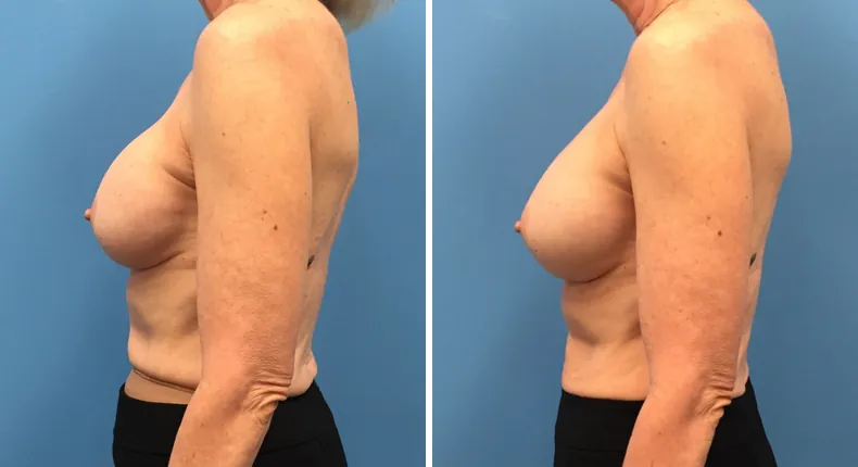 Before and after revision breast augmentation: patient's breasts from the left side