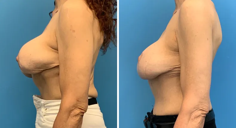 Before and after revision breast augmentation: patient's breasts from the left side
