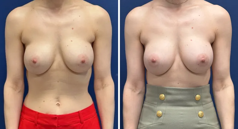 Before and after revision breast augmentation: patient's breasts from the front