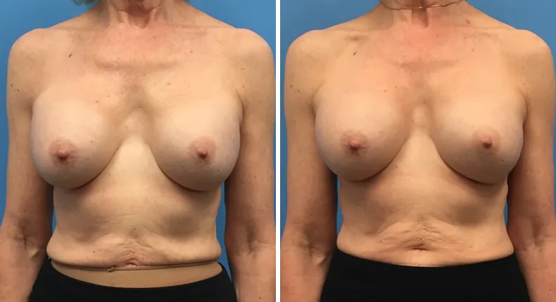 Before and after revision breast augmentation: patient's breasts from the front