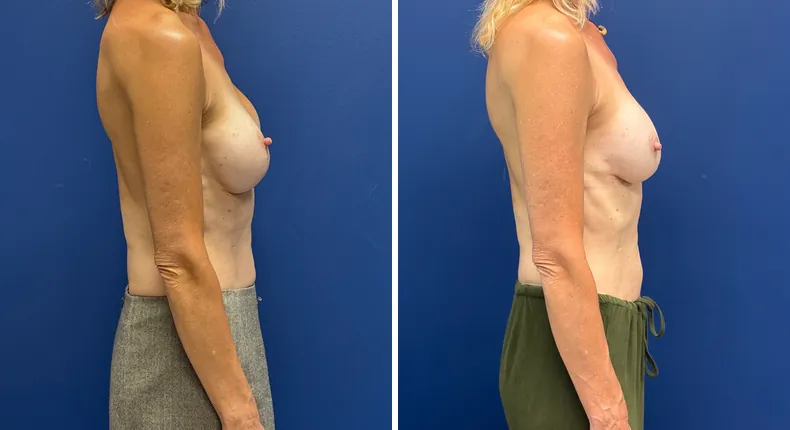 Before and after revision breast augmentation: woman's breasts