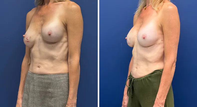 Before and after revision breast augmentation: woman's breasts