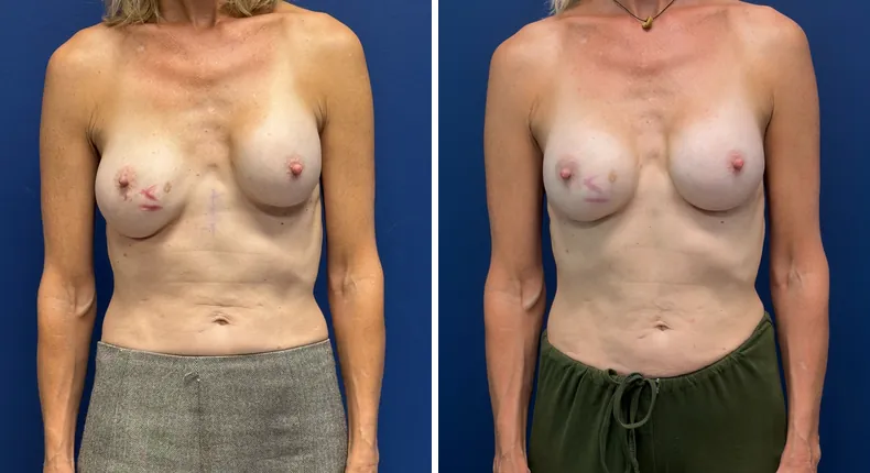 Before and after revision breast augmentation: woman's breasts