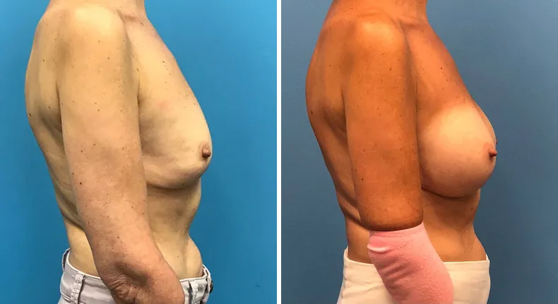 Before and after revision breast augmentation: woman's breasts from the right side