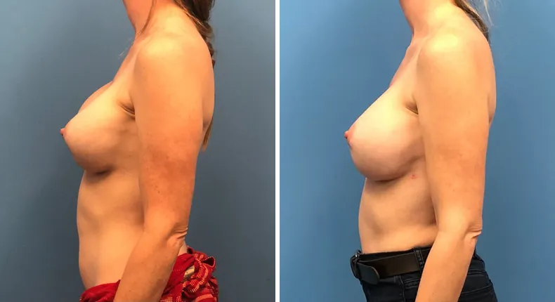 Before and after revision breast augmentation: woman's breasts in left profile