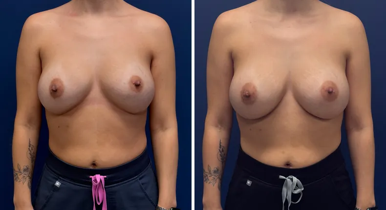 Before and after revision breast augmentation: patient's breasts