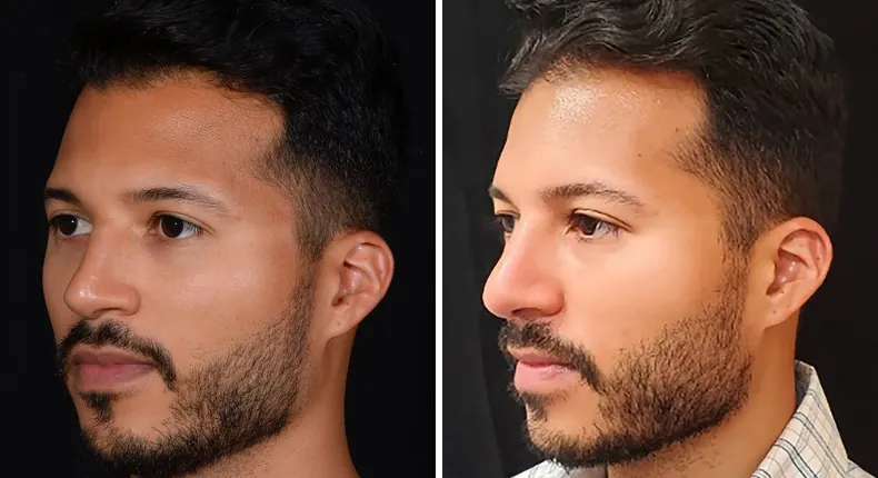 Before and after male rhinoplasty: patient's nose at a left angle