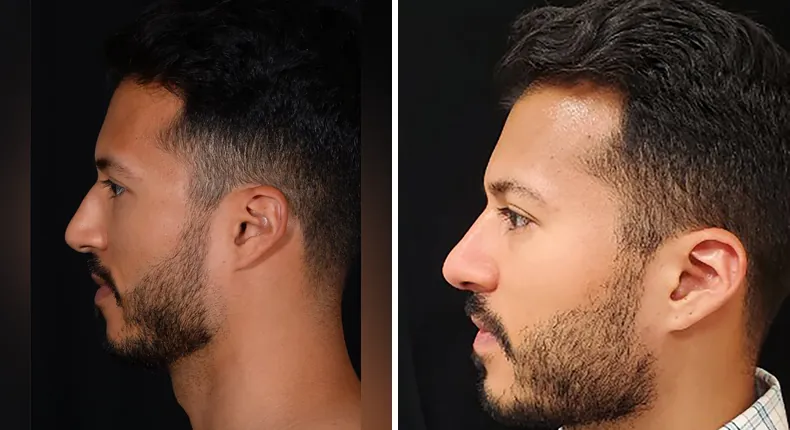 Before and after male rhinoplasty: patient's nose in left profile