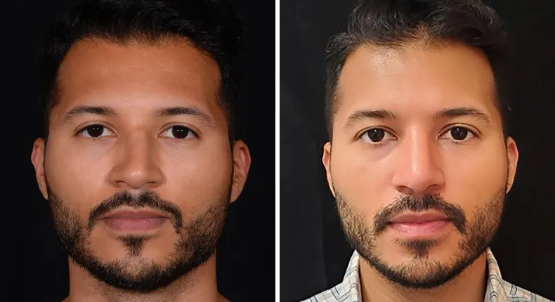 Before and after male rhinoplasty: patient's nose from the front