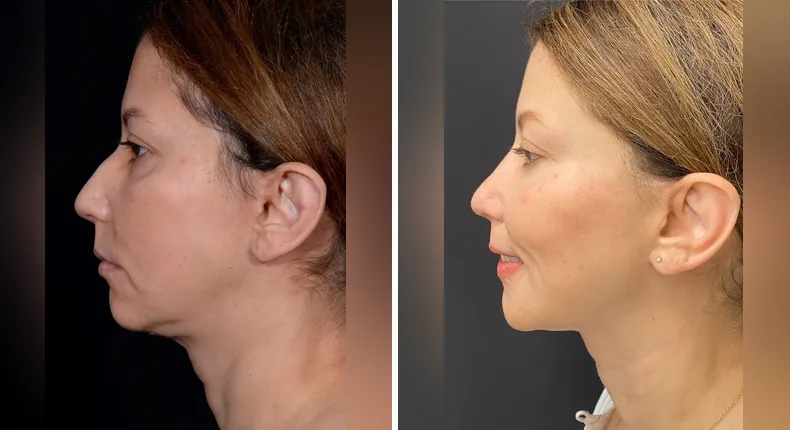 Before and after rhinoplasty: patient's nose from the left side