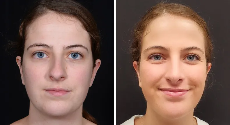 Before and after rhinoplasty: patient's nose from the front