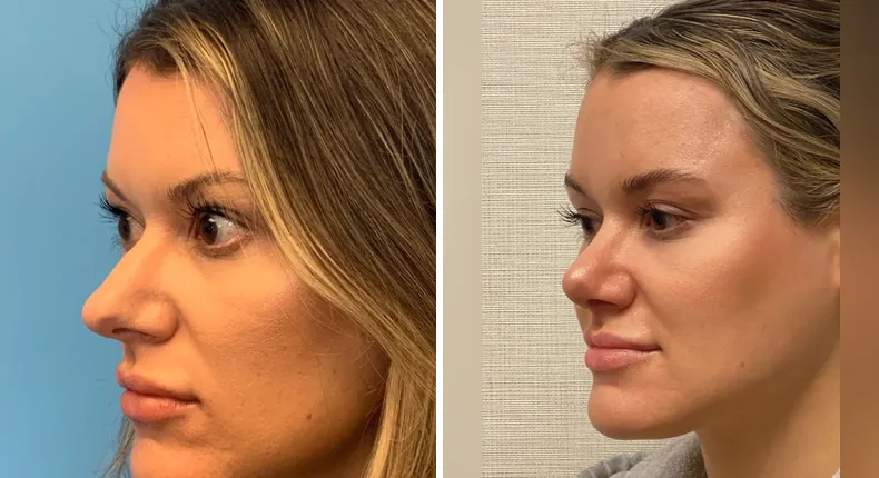 Before and after rhinoplasty: patient's nose at a left angle