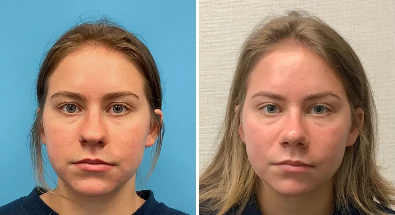 Before and after rhinoplasty: patient's nose from the front