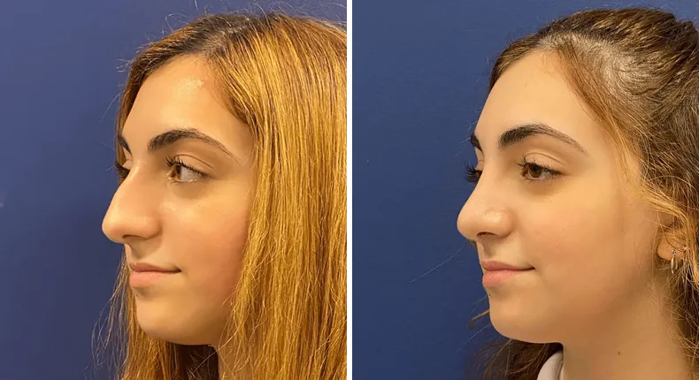 Before and after rhinoplasty: woman's nose at a left angle