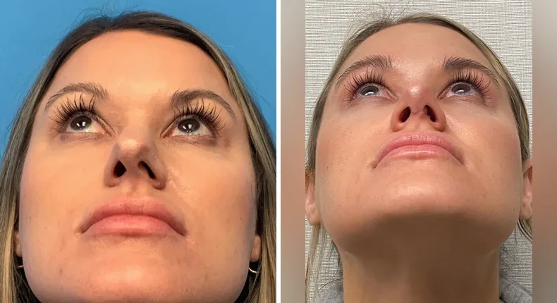 Before and after rhinoplasty: patient's nose