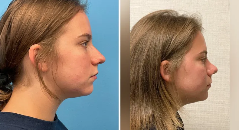 Before and after rhinoplasty: patient's nose from the right side