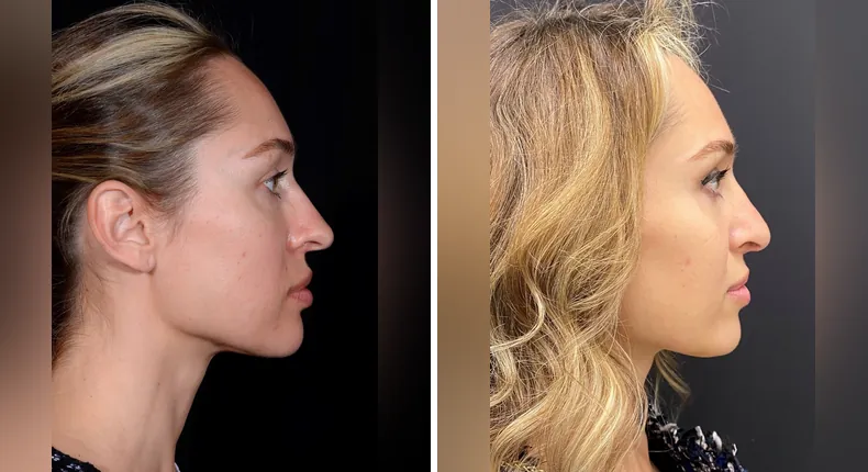 Before and after rhinoplasty: patient's nose from the right side