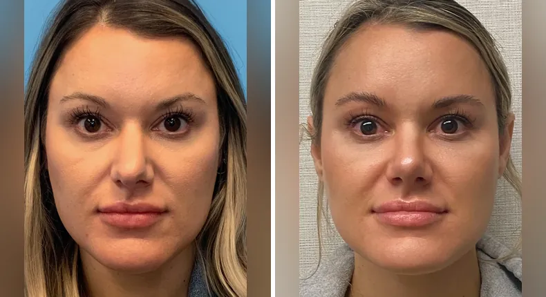 Before and after rhinoplasty: patient's nose from the front