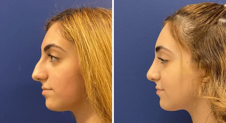 Before and after rhinoplasty: woman's nose in left profile
