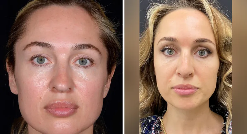 Before and after rhinoplasty: patient's nose from the front