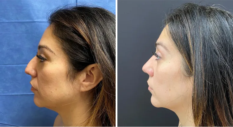 Before and after rhinoplasty: patient's nose from the left side