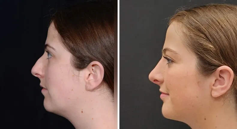 Before and after rhinoplasty: patient's nose from the left side