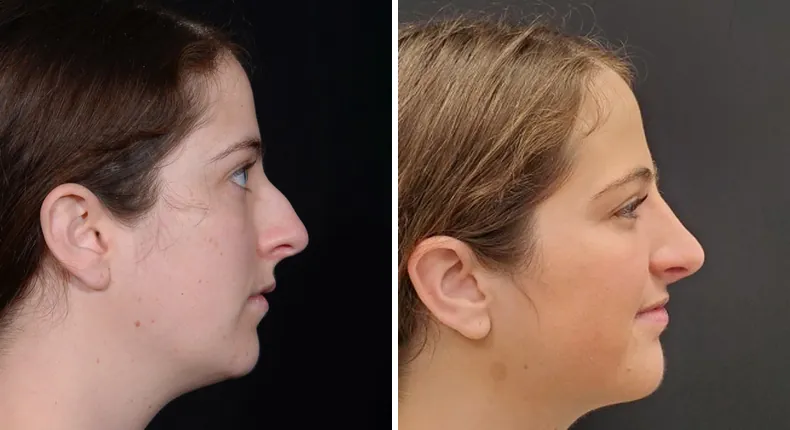 Before and after rhinoplasty: patient's nose from the right side