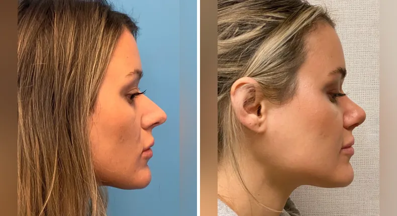 Before and after rhinoplasty: patient's nose in right profile