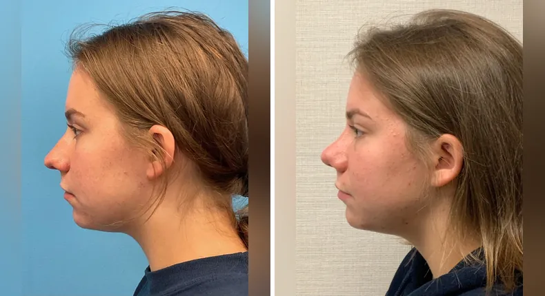 Before and after rhinoplasty: patient's nose from the left side