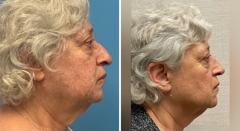 Before and after rhinoplasty: patient's nose from the right side