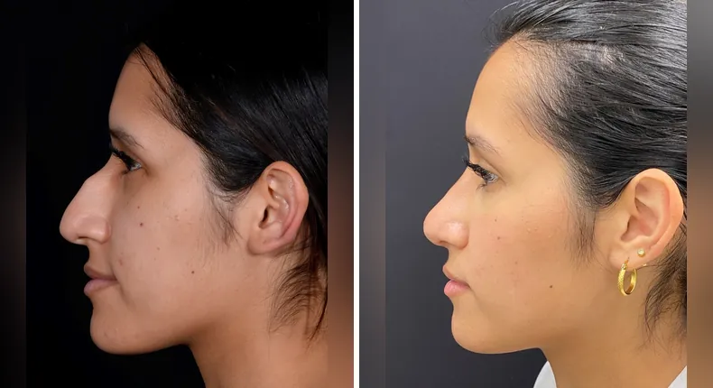 Before and after rhinoplasty: patient's nose from the left side