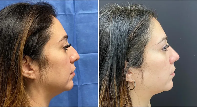 Before and after rhinoplasty: patient's nose from the right side