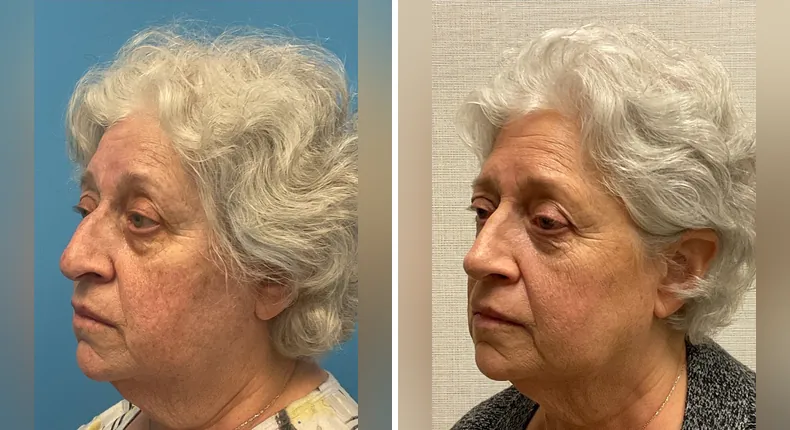 Before and after rhinoplasty: patient's nose at a left angle