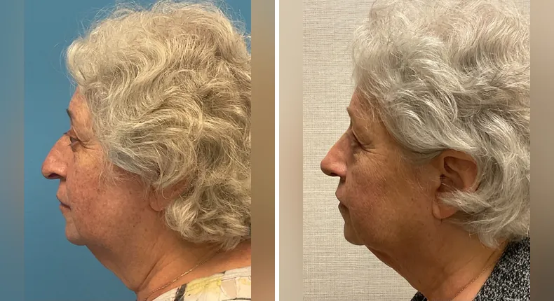 Before and after rhinoplasty: patient's nose from the left side