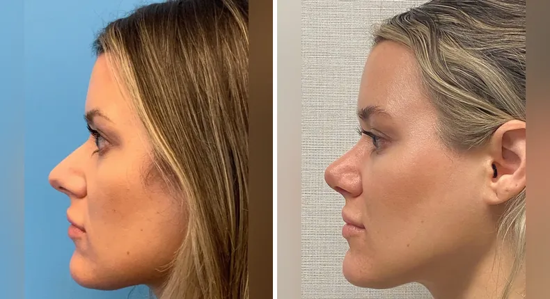 Before and after rhinoplasty: patient's nose in left profile