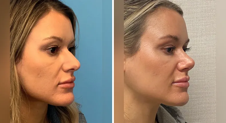 Before and after rhinoplasty: patient's nose at a right angle
