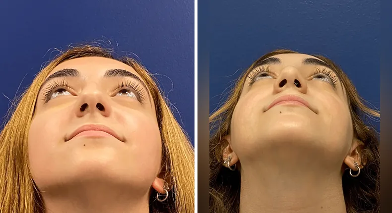 Before and after rhinoplasty: woman's nose