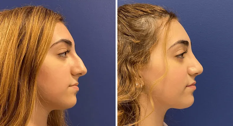 Before and after rhinoplasty: woman's nose in right profile