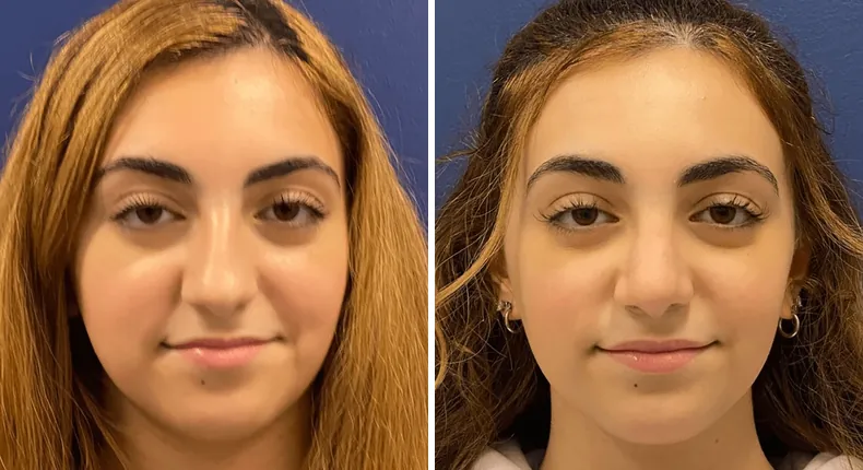 Before and after rhinoplasty: woman's nose from the front