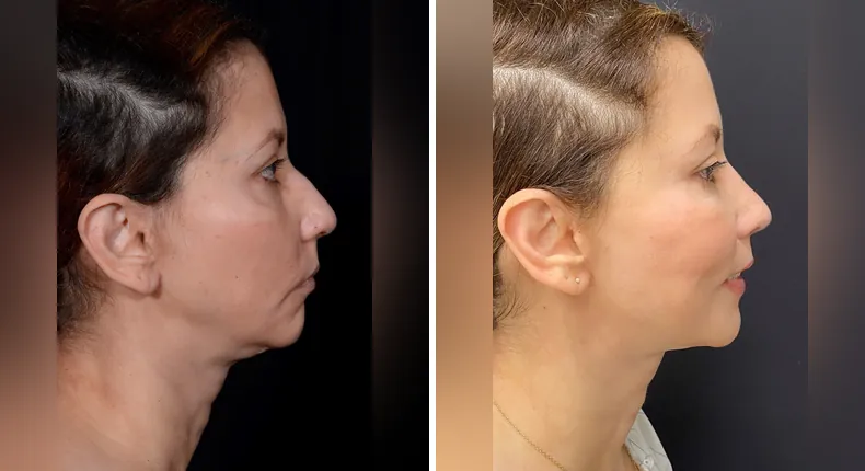 Before and after rhinoplasty: patient's nose from the right side