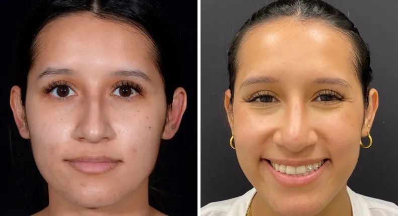 Before and after rhinoplasty: patient's nose from the front