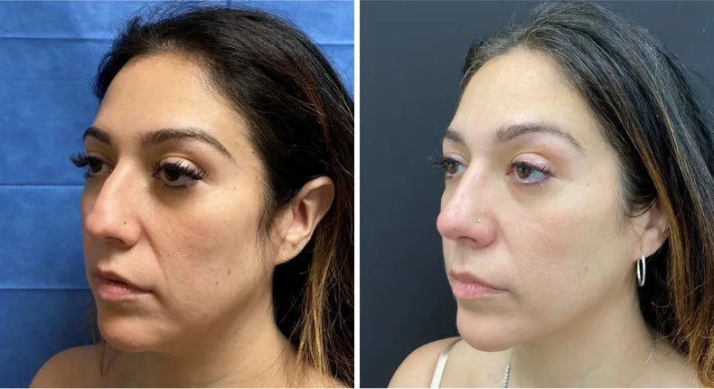 Before and after rhinoplasty: patient's nose at a left angle