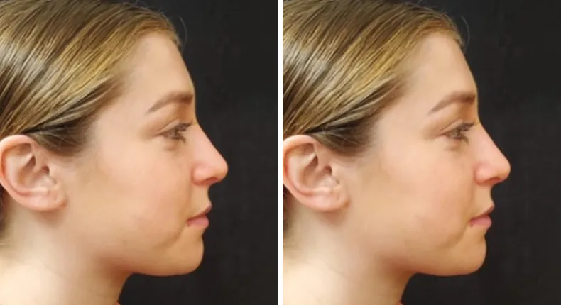 Before and after rhinoplasty: patient's nose