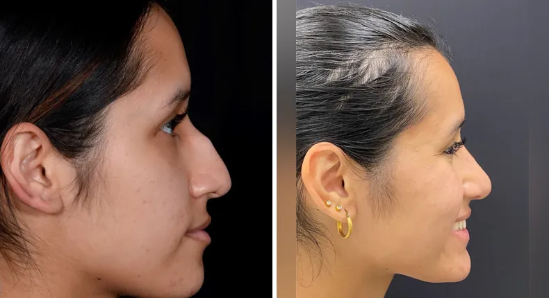 Before and after rhinoplasty: patient's nose from the right side