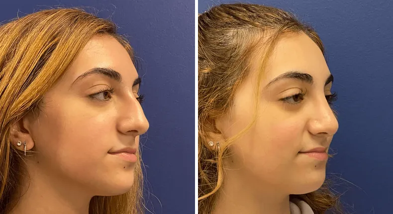 Before and after rhinoplasty: woman's nose at a right angle