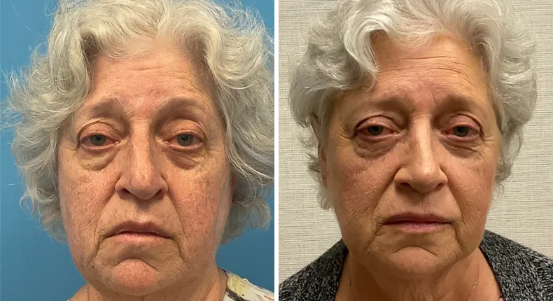 Before and after rhinoplasty: patient's nose from the front