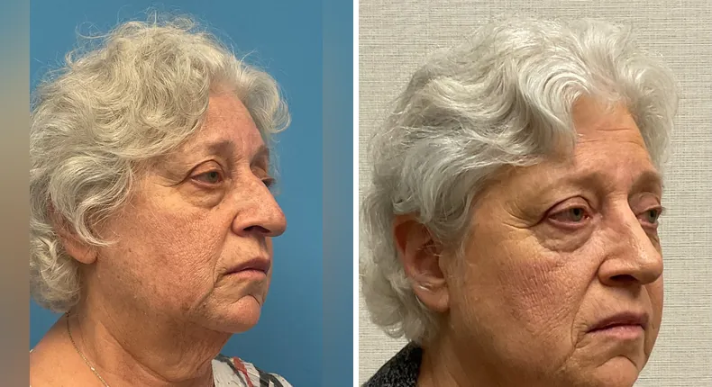 Before and after rhinoplasty: patient's nose at a right angle